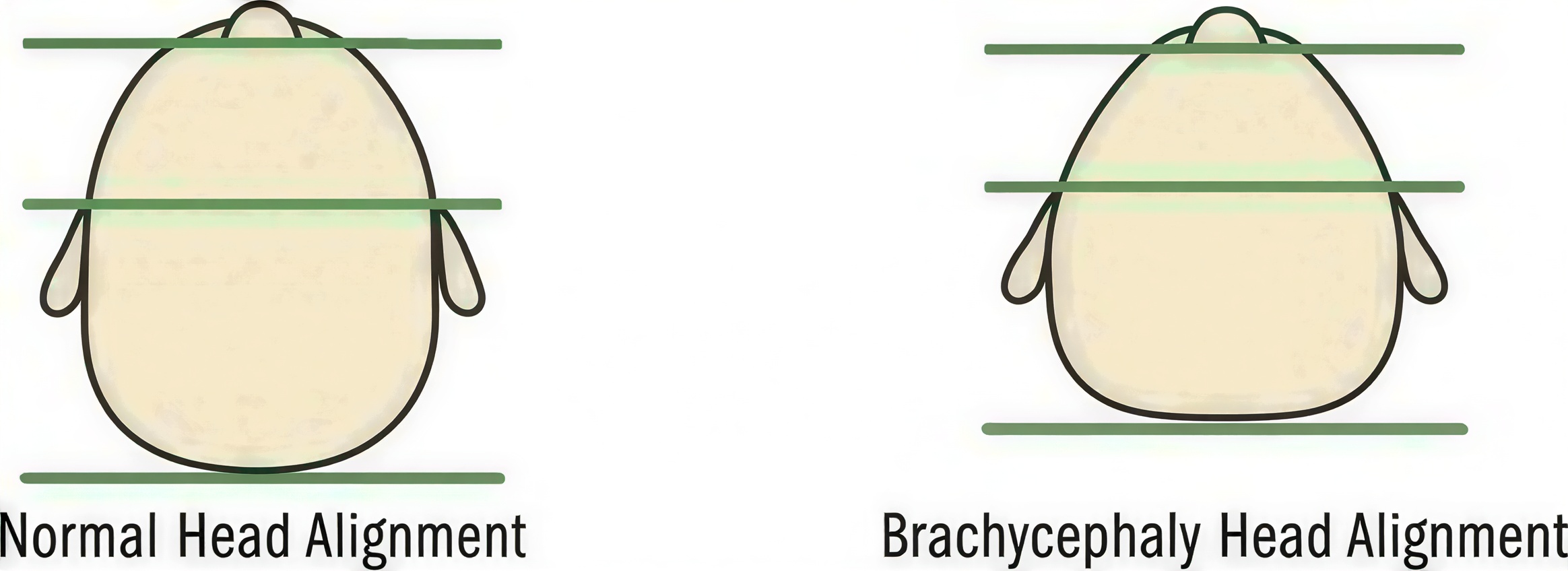 Infant with brachycephaly illustration