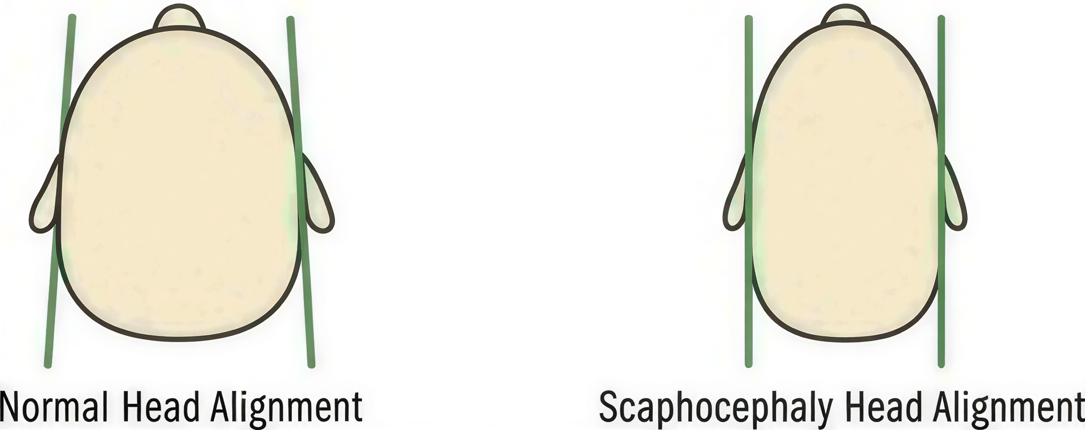 Infant with scaphocephaly illustration